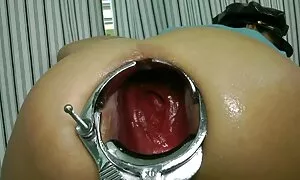 Speculum prolapse mi ...