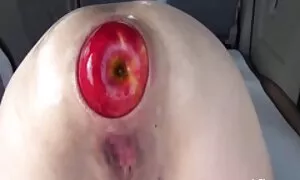 Anal totohondry extr ...